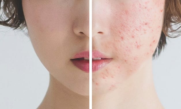 なかなか治らないニキビ肌。その原因を知ることはとても大切！