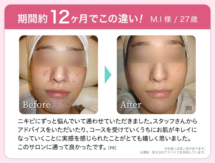 期間約12ヶ月でこの違い! M.I 様 / 27歳 Before After ニキビにずっと悩んでいて通わせていただきました。スタッフさんからアドバイスをいただいたり、コースを受けていくうちにお肌がキレイになっていくことに実感を感じられたことがとても嬉しく思いました。このサロンに通って良かったです。 ※効果には個人差があります。※運動・食生活のアドバイスを実施しています。