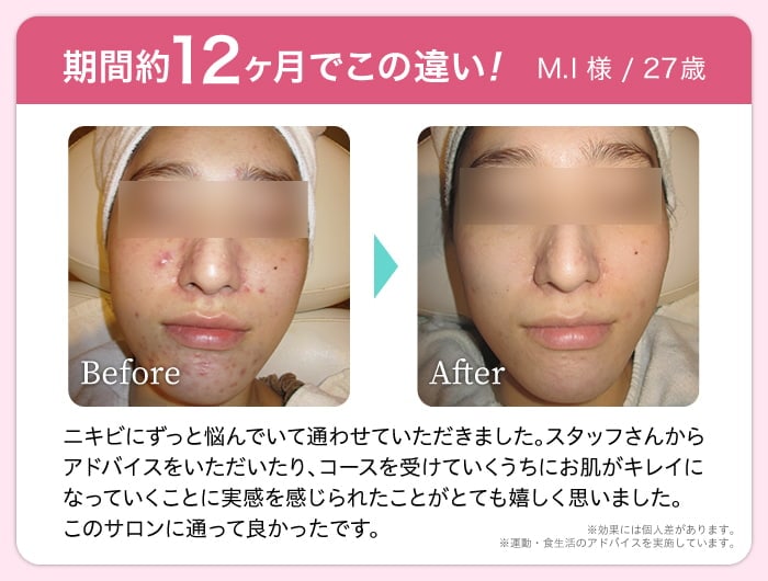 期間約12ヶ月でこの違い! M.I 様 / 27歳 Before After ニキビにずっと悩んでいて通わせていただきました。スタッフさんからアドバイスをいただいたり、コースを受けていくうちにお肌がキレイになっていくことに実感を感じられたことがとても嬉しく思いました。このサロンに通って良かったです。 ※効果には個人差があります。※運動・食生活のアドバイスを実施しています。