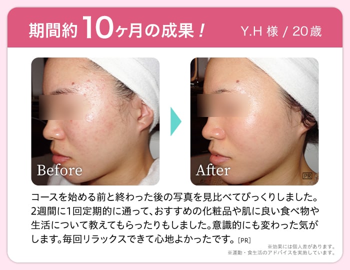 期間約10ヶ月の成果! Y.H 様 / 20歳 Before After コースを始める前と終わった後の写真を見比べてびっくりしました。2週間に1回定期的に通って、おすすめの化粧品や肌に良い食べ物や 生活について教えてもらったりもしました。意識的にも変わった気が します。毎回リラックスできて心地よかったです。※効果には個人差があります。※運動・食生活のアドバイスを実施しています。