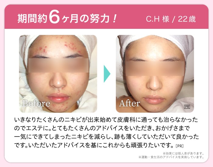 期間約6ヶ月の努力! C.H 様 / 22歳 Before After いきなりたくさんのニキビが出来始めて皮膚科に通っても治らなかった のでエステに。とてもたくさんのアドバイスをいただき、おかげさまで 一気にできてしまったニキビを減らし、跡も薄くしていただいて良かった です。いただいたアドバイスを基にこれからも頑張りたいです。※効果には個人差があります。※運動・食生活のアドバイスを実施しています。