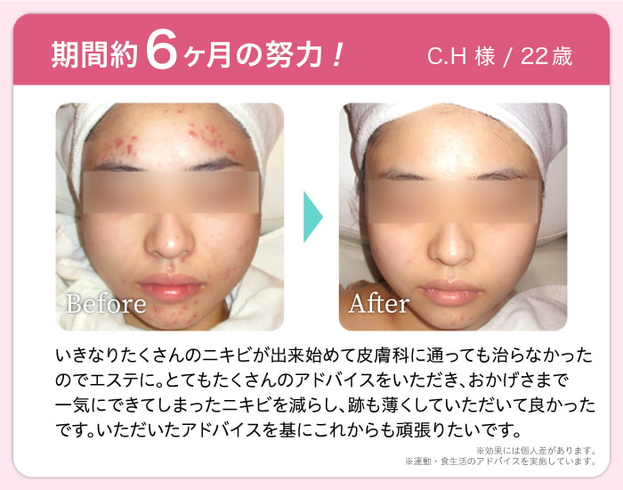 期間約6ヶ月の努力! C.H 様 / 22歳 Before After いきなりたくさんのニキビが出来始めて皮膚科に通っても治らなかった のでエステに。とてもたくさんのアドバイスをいただき、おかげさまで 一気にできてしまったニキビを減らし、跡も薄くしていただいて良かった です。いただいたアドバイスを基にこれからも頑張りたいです。※効果には個人差があります。※運動・食生活のアドバイスを実施しています。