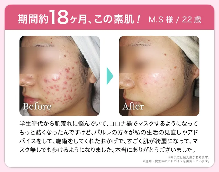 期間約18ヶ月、この素肌! M.S様22歳  Before After 学生時代から肌荒れに悩んでいて、コロナ禍でマスクするようになってもっと酷くなったんですけど、パルレの方々が私の生活の見直しやアドバイスをして、施術をしてくれたおかげで、すごく肌が綺麗になって、マスク無しでも歩けるようになりました。本当にありがとうございました。※効果には個人差があります。※運動・食生活のアドバイスを実施しています。