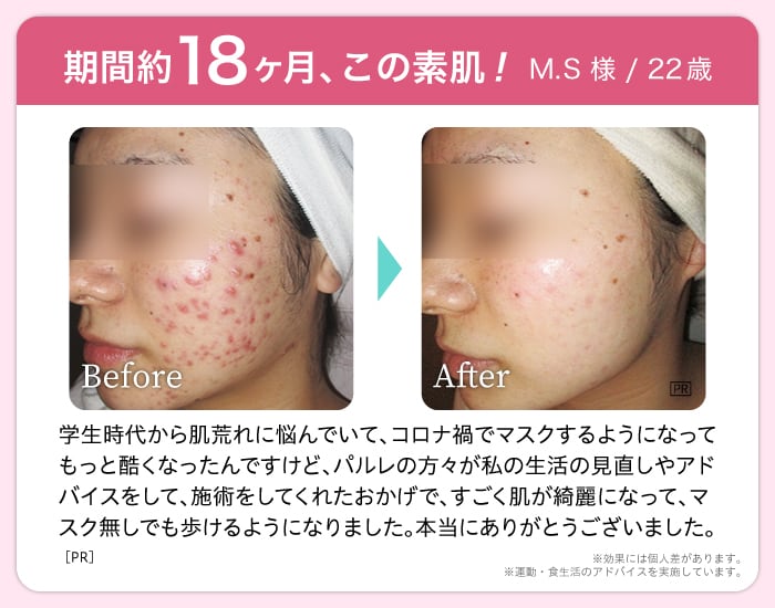 期間約18ヶ月、この素肌! M.S様22歳 Before After 学生時代から肌荒れに悩んでいて、コロナ禍でマスクするようになってもっと酷くなったんですけど、パルレの方々が私の生活の見直しやアドバイスをして、施術をしてくれたおかげで、すごく肌が綺麗になって、マスク無しでも歩けるようになりました。本当にありがとうございました。※効果には個人差があります。※運動・食生活のアドバイスを実施しています。