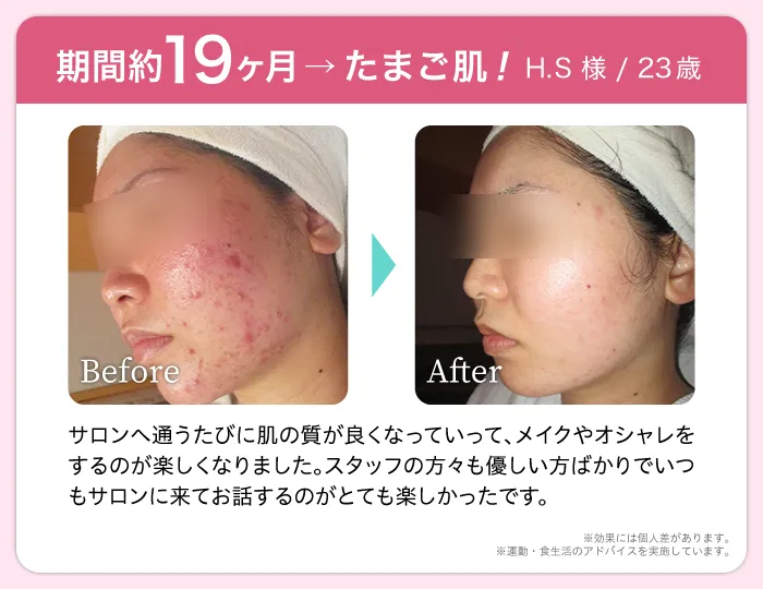 期間約19ヶ月→たまご肌! H.S 様 23歳  Before After サロンへ通うたびに肌の質が良くなっていって、メイクやオシャレをするのが楽しくなりました。スタッフの方々も優しい方ばかりでいつもサロンに来てお話するのがとても楽しかったです。※効果には個人差があります。※運動・食生活のアドバイスを実施しています。