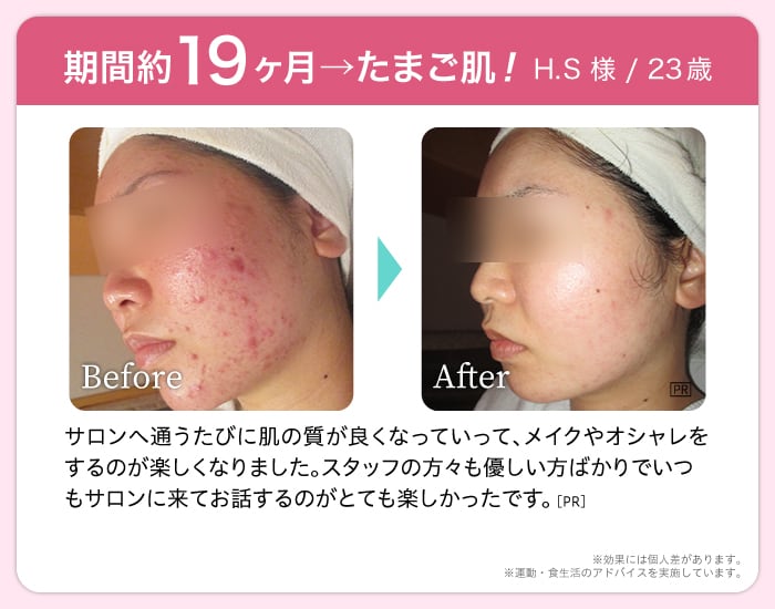 期間約19ヶ月→たまご肌! H.S 様 23歳 Before After サロンへ通うたびに肌の質が良くなっていって、メイクやオシャレをするのが楽しくなりました。スタッフの方々も優しい方ばかりでいつもサロンに来てお話するのがとても楽しかったです。※効果には個人差があります。※運動・食生活のアドバイスを実施しています。