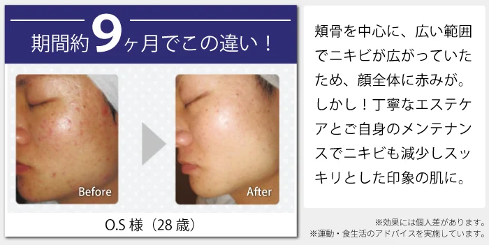 期間約9ヶ月でこの違い！ O.S様（28歳）before after 頬骨を中心に、広い範囲でニキビが広がっていたため、顔全体に赤みが。しかし！丁寧なエステケアとご自身のメンテナンスでニキビも減少しスッキリとした印象の肌に。※効果には個人差があります。※運動・食生活のアドバイスを実施しています。
