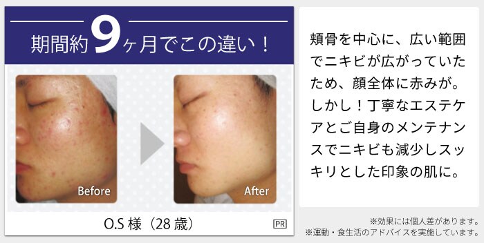 期間約9ヶ月でこの違い！ O.S様（28歳）before after 頬骨を中心に、広い範囲でニキビが広がっていたため、顔全体に赤みが。しかし！丁寧なエステケアとご自身のメンテナンスでニキビも減少しスッキリとした印象の肌に。※効果には個人差があります。※運動・食生活のアドバイスを実施しています。