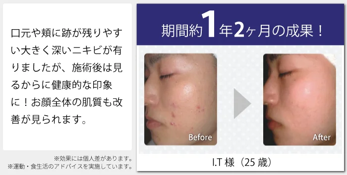 期間約1年2ヶ月の成果！ I.T様（25歳） before after 口元や頬に跡が残りやすい大きく深いニキビが有りましたが、施術後は見るからに健康的な印象に！お顔全体の肌質も改善が見られます。※効果には個人差があります。※運動・食生活のアドバイスを実施しています。