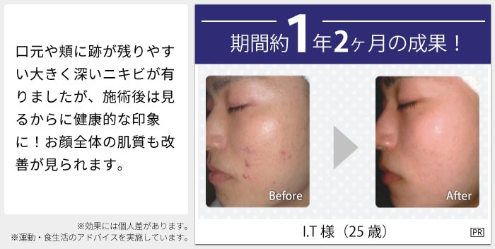 期間約1年2ヶ月の成果！ I.T様（25歳） before after 口元や頬に跡が残りやすい大きく深いニキビが有りましたが、施術後は見るからに健康的な印象に！お顔全体の肌質も改善が見られます。※効果には個人差があります。※運動・食生活のアドバイスを実施しています。