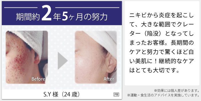 期間約2年5ヶ月の努力 S.Y様（24歳） before after ニキビから炎症を起こして、大きな範囲でクレーター（陥没）となってしまったお客様。長期間のケアと努力で驚くほど白い美肌に！継続的なケアはとても大切です。 ※効果には個人差があります。※運動・食生活のアドバイスを実施しています。