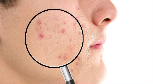 市販薬の服用や皮膚科の治療でもなかなか治らない頑固なニキビ