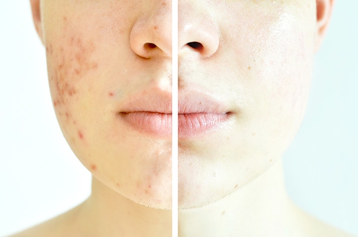 なかなか治らないニキビ肌。その原因を知ることはとても大切！