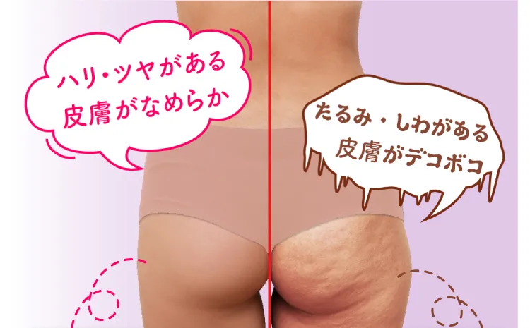 ハリ・ツヤがある健康な肌質に比べ、セルライトが付着しているとたるみ・しわがあり皮膚がデコボコに。特にお腹、お尻、太もも周りに発生しやすい