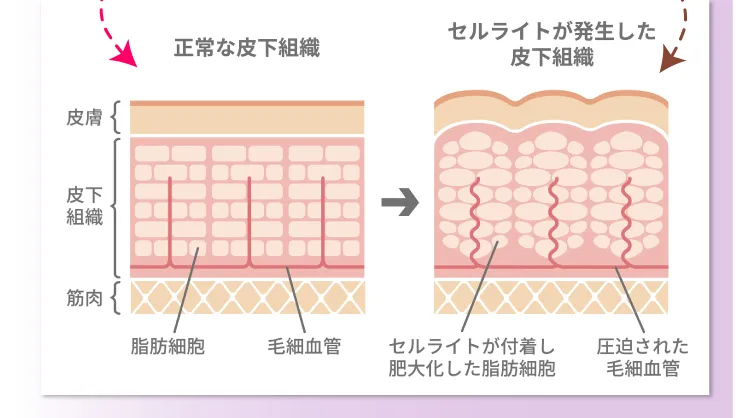 正常な皮下組織とセルライトが発生した皮下組織の比較図