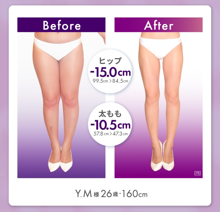 Y.M様 26歳 160cm Before After