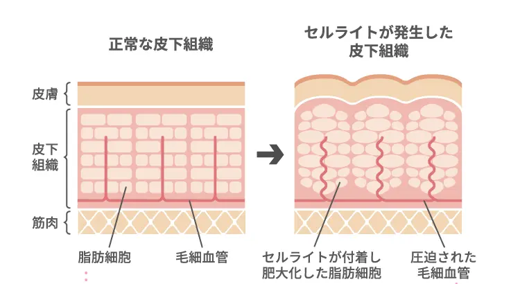正常な皮下組織とセルライトが発生した皮下組織の比較図