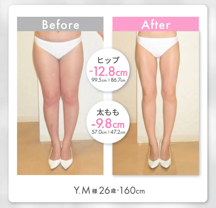 Y.M様 26歳 160cm Before After