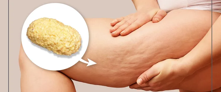 ボコボコしたセルライトはなかなか落ちてくれない…