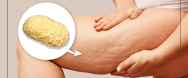 ボコボコしたセルライトはなかなか落ちてくれない…