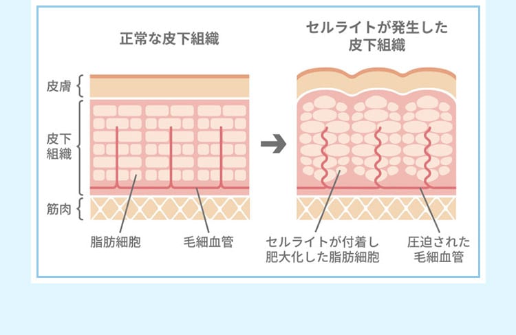 正常な皮下組織 セルライトが発生した皮下組織 皮膚 皮下組織 筋肉 脂肪細胞 毛細血管 セルライトが付着し肥大化した脂肪細胞 圧迫された毛細血管