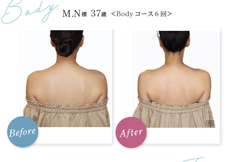 Body M.N様 37歳 Before After Body コース6回 首筋から背中がスッキリ！天使の羽根もしっかり見える状態に