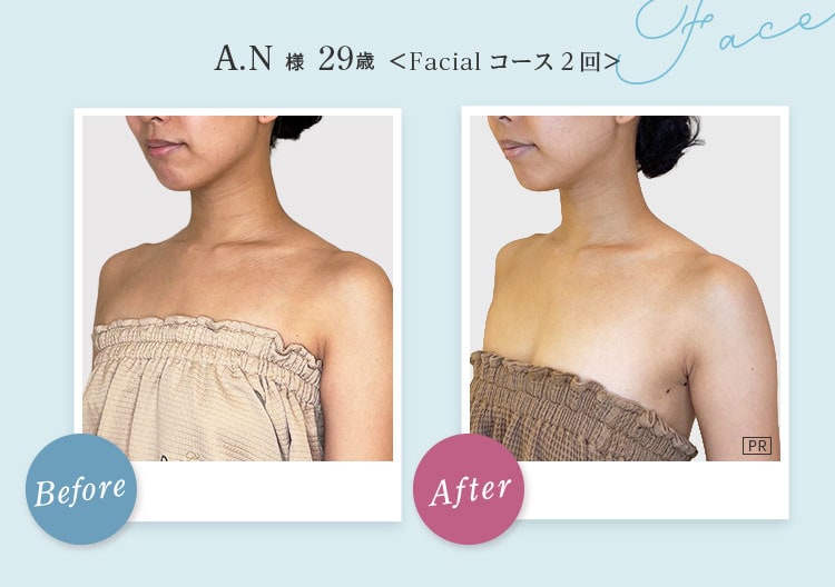 Face A.N様 29歳 Before After Facial コース2回 フェイスラインからデコルテにかけてラインがスッキリスリムに