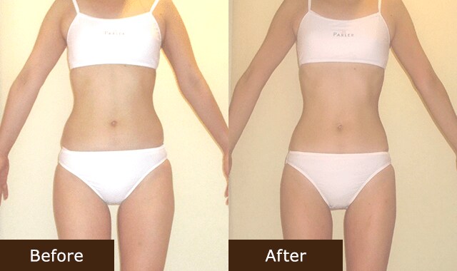 ビフォア＆アフター U.A様(25歳)