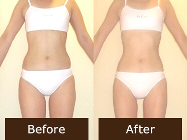 ビフォア＆アフター U.A様(25歳)