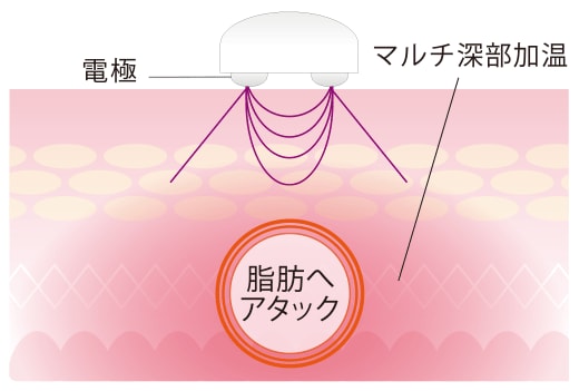 RF波が深部を加温し脂肪へアタック