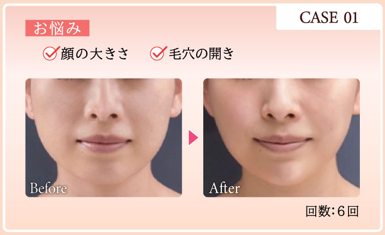 CASE01 お悩み：顔の大きさ 毛穴の開き Before After 回数：6回