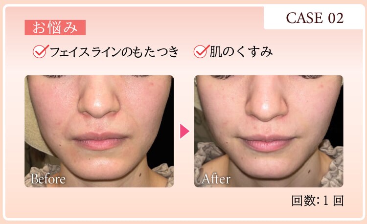 CASE02 お悩み：フェイスラインのもたつき 肌のくすみ Before After 回数：1回