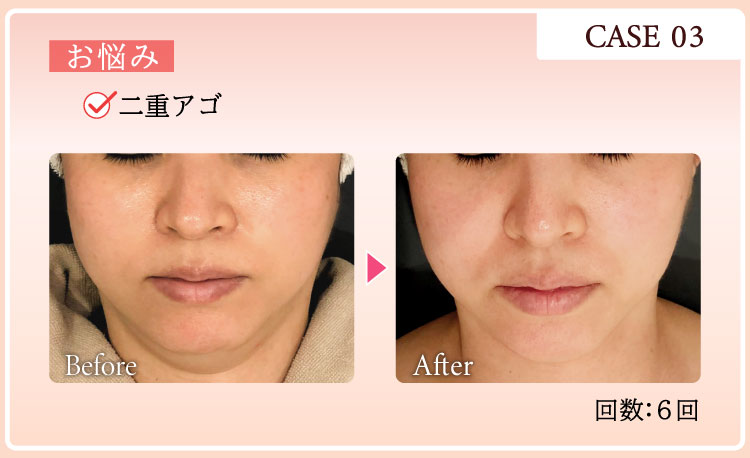 CASE03 お悩み：二重アゴ Before After 回数：6回