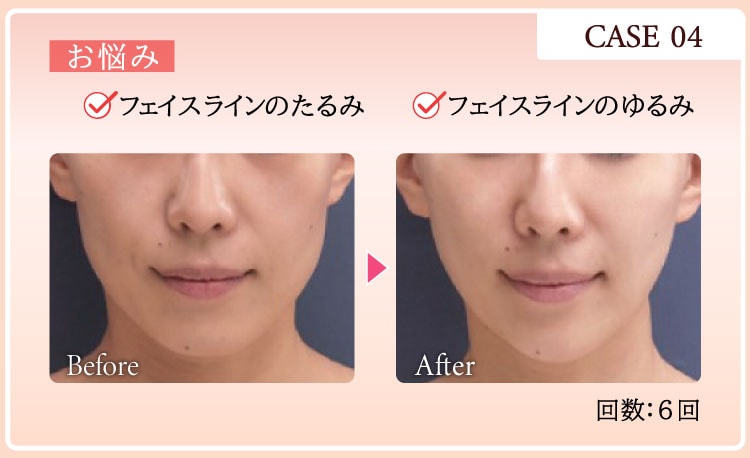 CASE04 お悩み：フェイスラインのもたつき フェイスラインのたるみ Before After 回数：6回