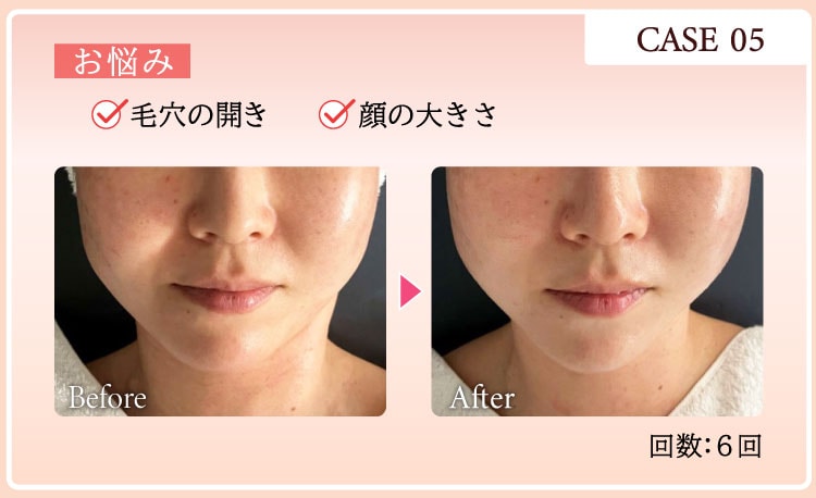 CASE05 お悩み：毛穴の開き 眉間のしわ Before After 回数：6回