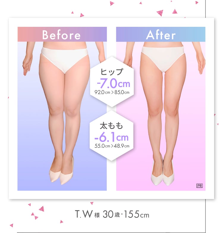 太もも -6.1cm！ T.W様（30歳・155cm）
Before-After ヒップ -7.0cm！ 92.0cm → 85.0cm 太もも -6.1cm！ 55.0cm → 48.9cm