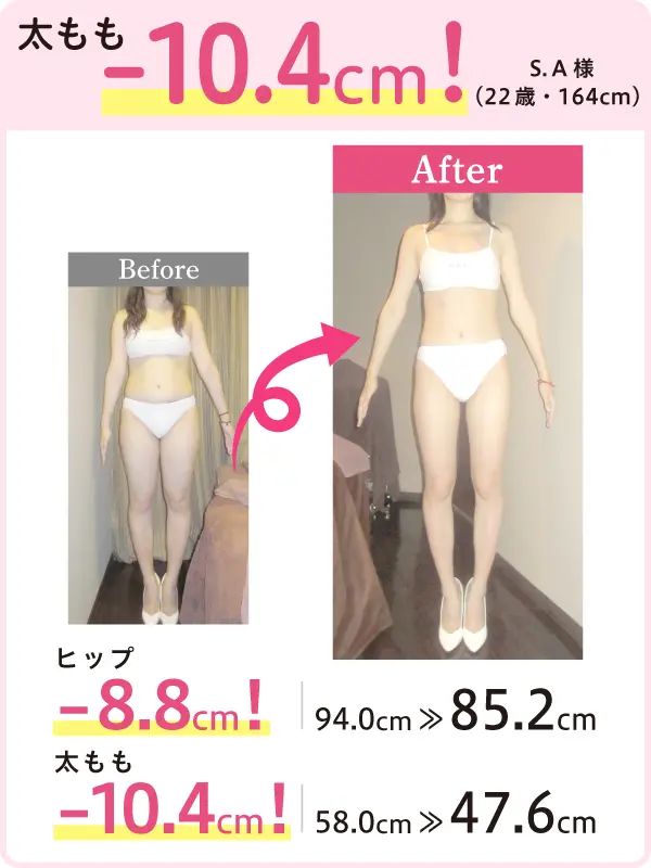 太もも -10.4cm！ S.A様（22歳・164cm） Before-After ヒップ -8.8cm！ 94.0cm → 85.2cm 太もも -10.4cm！ 58.0cm → 47.6cm