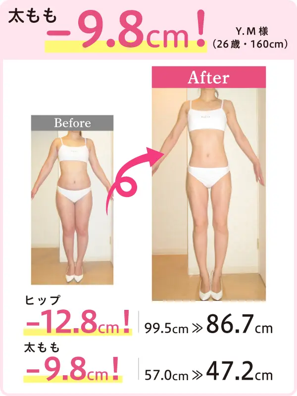 太もも -9.8cm！ Y.M様（26歳・160cm） Before-After ヒップ -12.8cm！ 99.5cm → 86.7cm 太もも -9.8cm！ 57.0cm → 47.2cm