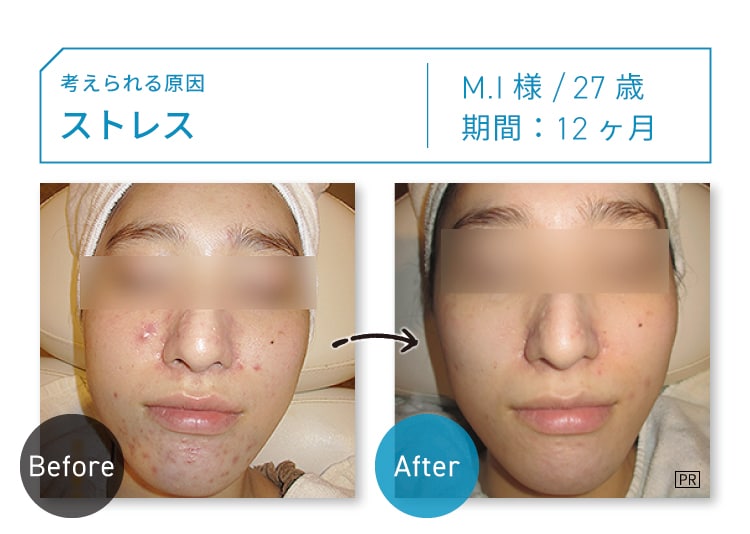 CASE01 考えられる原因：ストレス M.I様 27歳 期間：約12ヶ月 Before-After