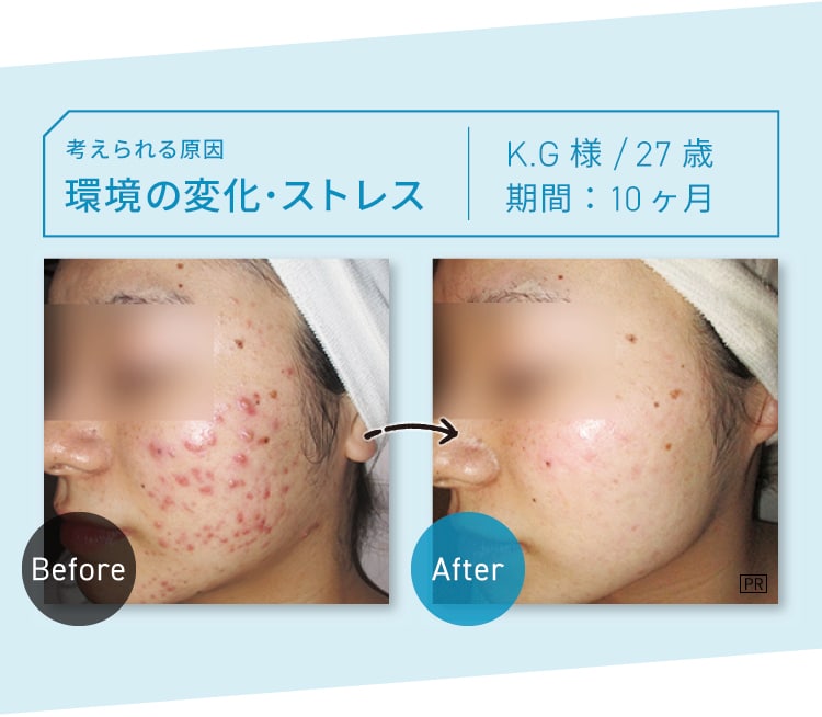 CASE04 考えられる原因：環境の変化・ストレス M.S様 22歳 期間：約18ヶ月 Before-After