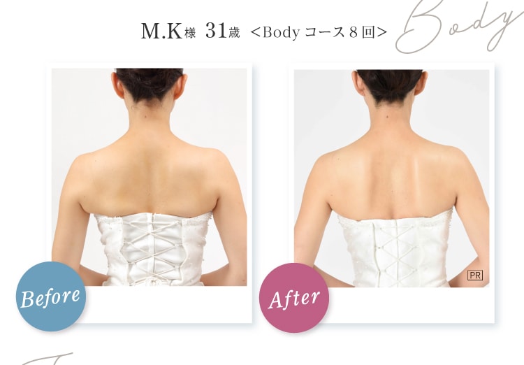 Body M.K様 31歳 Before After Body コース8回 首筋から背中がスッキリ！天使の羽根もしっかり見える状態に