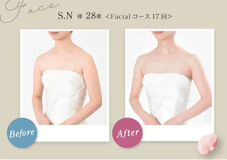 Face S.N様 28歳 Before After Facial コース17回 フェイスラインからデコルテにかけてラインがスッキリスリムに