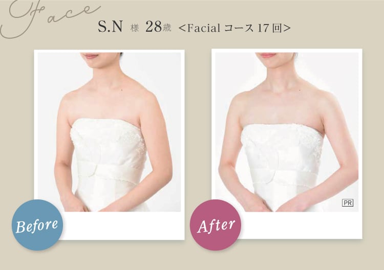 Face S.N様 28歳 Before After Facial コース17回 フェイスラインからデコルテにかけてラインがスッキリスリムに
