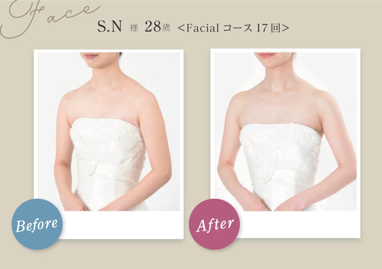 Face S.N様 28歳 Before After Facial コース17回 フェイスラインからデコルテにかけてラインがスッキリスリムに