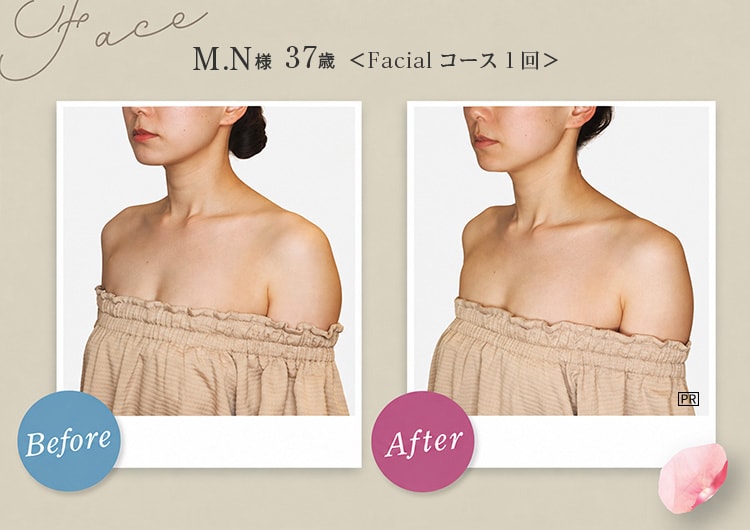 Face M.N様 37歳 Before After Facialコース1回！フェイスラインからデコルテにかけてラインがスッキリスリムに PR