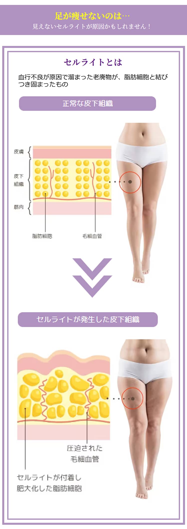 メソセルライト撃退コース（レディス）5