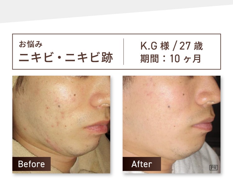 お悩み：ニキビ・ニキビ跡 H.K様 27歳 期間約10ヶ月 Before-After