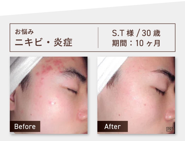 お悩み：ニキビ・炎症 S.T様 30歳 期間約10ヶ月 Before-After