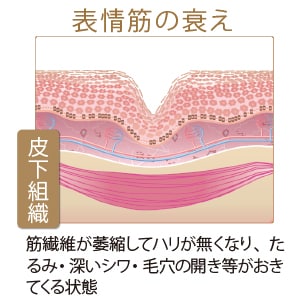 表情筋の衰え:筋繊維が委縮してハリが無くなり、たるみ・深いシワ・毛穴の開き等がおきてくる状態