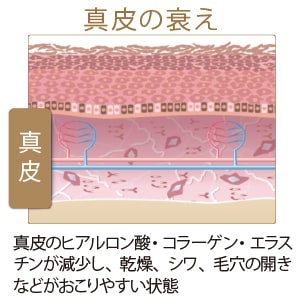 真皮の衰え:真皮のヒアルロン酸・コラーゲン・エラスチンが減少し、乾燥、シワ、毛穴の開きなどがおこりやすい状態